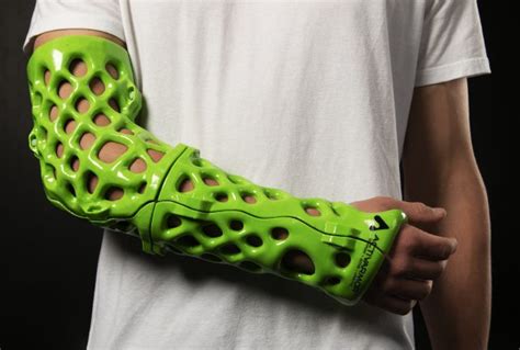 Broken bone? This cast makes healing a breeze - LVB