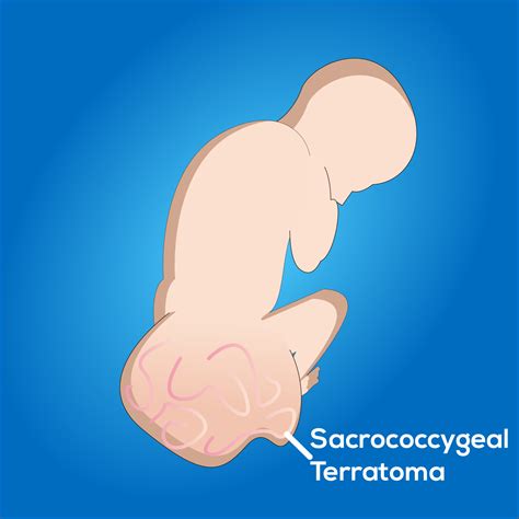 What are Teratomas? Pathophysiology, Types, Symptoms, Investigations ...