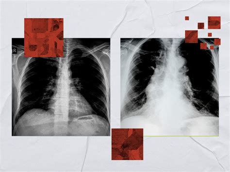 Emphysema Chest X Ray