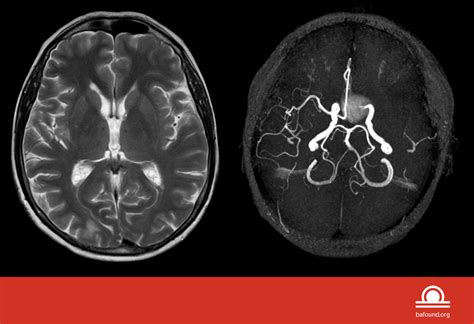 MRA vs. MRI - Brain Aneurysm Foundation