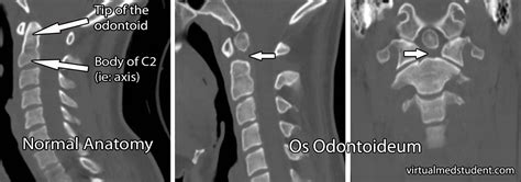 wierd... os odontoideum | Medical pictures, Bone diseases, Medical