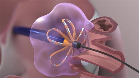 Medical Device Animation: Atrial Fibrillation Ablation Surgery - YouTube