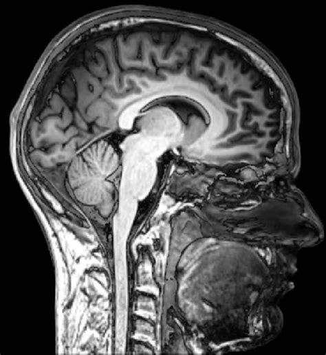 mri scan normal brain sagital view - Neuroscience News