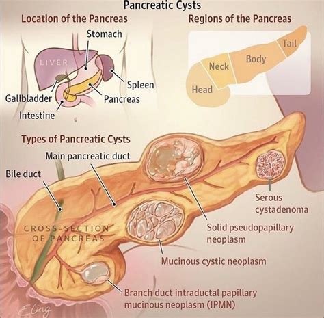 Quistes Pancreaticos | Diagnostic medical sonography, Medical anatomy ...