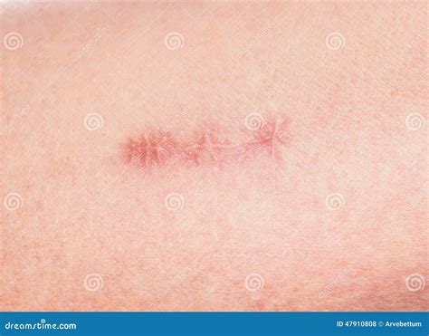 Redness Around Healing Stitches on Skin Stock Photo - Image of damage ...