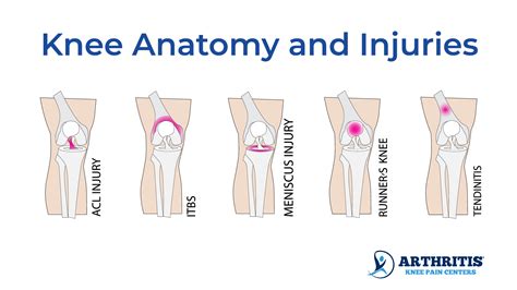 Knee Pain Location Chart - Arthritis Knee Pain Centers