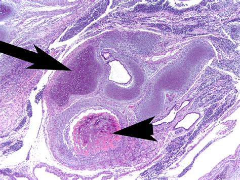 Examples of important visual cues in histology. (left) In this teratoma ...