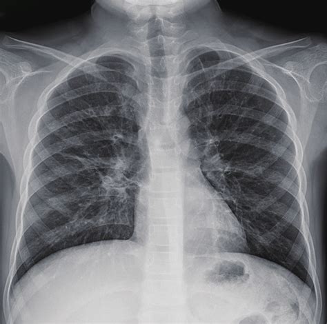 Chest X-ray demonstrating diffuse, bilateral bronchiectasis. | Download ...