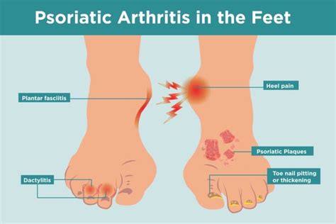 Psoriatic Arthritis in the Feet: Symptoms, Treatment, Home Remedies