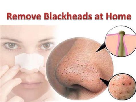 How to Remove Blackheads From Nose