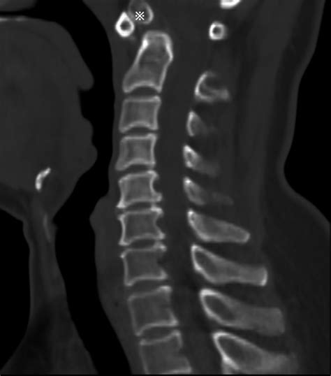 Sagittal CT view showing os odontoideum (※). | Download Scientific Diagram