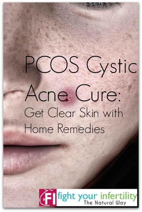 PCOS Cystic Acne Cure – Get Clear Skin with Home Remedies