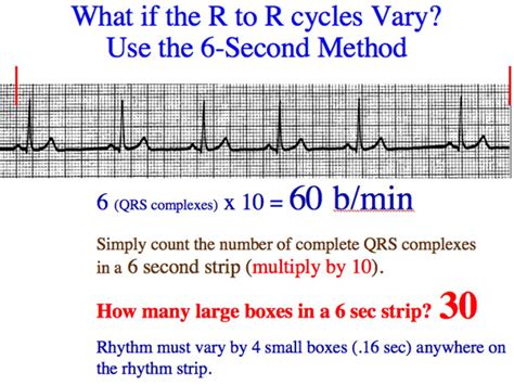 Ecg Irregular Heart Rate Calculation - Photos Idea