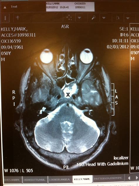 Mri Brain Scan Results White Spots