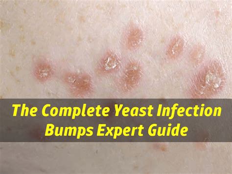 Yeast Infection Bumps - Are Your Skin Bumps Caused By Yeast Infection?