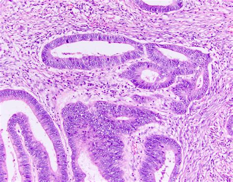 Adenocarcinoma Colon Histology