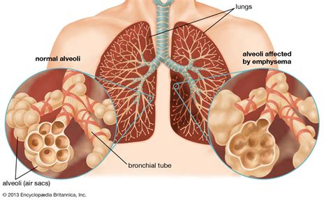 Emphysema | Causes, Symptoms & Treatment | Britannica