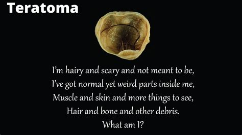 What are Teratomas? Pathophysiology, Types, Symptoms, Investigations ...