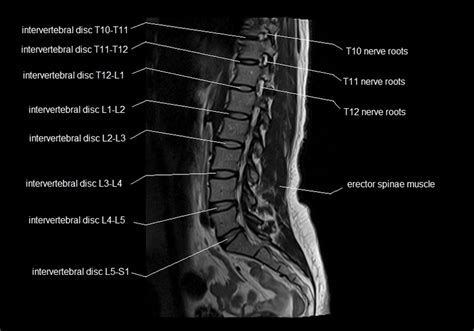 MRI spine anatomy | free MRI lumbar spine sagittal cross sectional anatomy