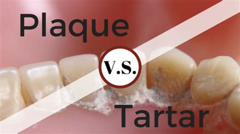 Plaque vs. Tartar: What's The Difference? - Britt Dental Center ...