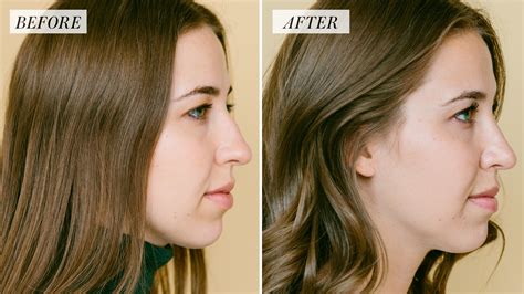 Nose Filler Nose Shaping Rhinoplasty NYC Dr. Brett Kotlus