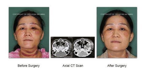 Craniofacial Trauma Reconstruction – MSPRS