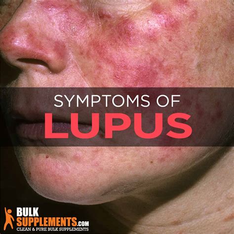 What is Lupus: Signs, Causes, Symptoms & Treatment