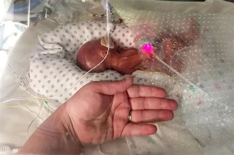 Miracle baby born weighing just over 1lb with translucent skin and ...