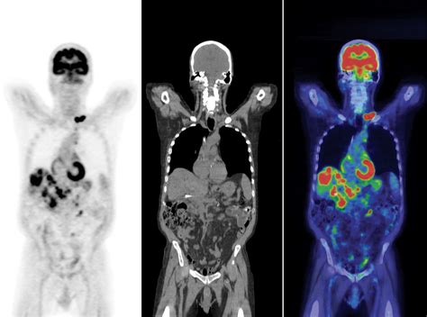 PETCT Scan - Parkside Hospital