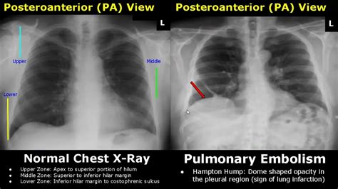 Pneumothorax Chest X Ray Chest X Ray At Presentation Pneumothorax The ...