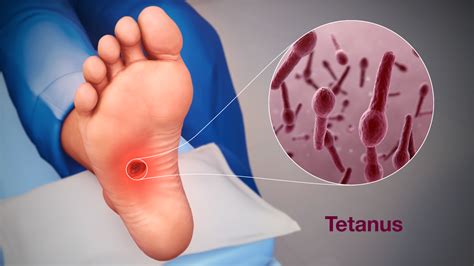 Tétanos: symptômes, causes et traitement - Fmedic