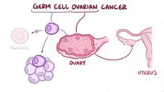 Teratoma: What Is It, Signs, Symptoms, and More | Osmosis