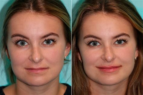 Lip Augmentation photos | Chevy Chase, MD | Patient 17093