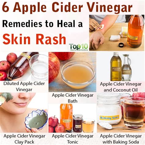 6 Apple Cider Vinegar Remedies to Heal a Skin Rash | Top 10 Home Remedies