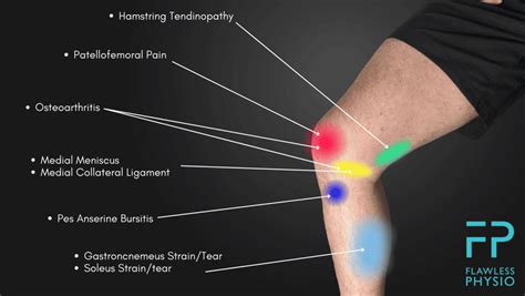 Knee Pain Location Chart - Find the Cause of Your Knee Pain