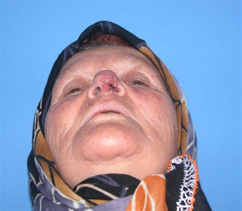 Lupus Pernio - Tuberculoid Leprosy - Dermatopathology - Mussen ...