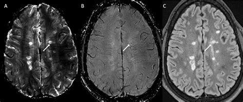 Multiple sclerosis lesion magnetic susceptibility activity | Department ...