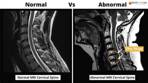 Normal Vs Abnormal Mri Cervical Spine