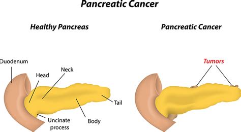 Pancreatic Cancer-Causes,Symptoms,Treatment in Bangalore