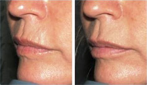 Upper Lip Lines | Mouth Wrinkles | Smokers Lines : Cosmetic injectable ...