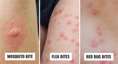 Bed Bug Bites - Identification, Prevention & Treatment