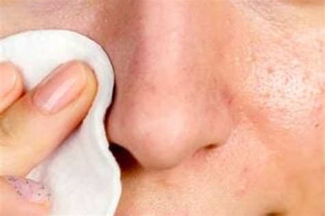 5 Safest Home Remedies to Remove Blackheads