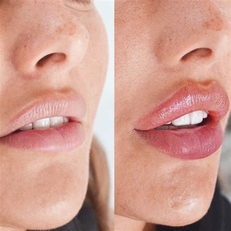 Russian Lip Filler Before & After | Skinly Aesthetics