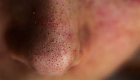 Blackheads: What They Look Like, Treatment & Prevention