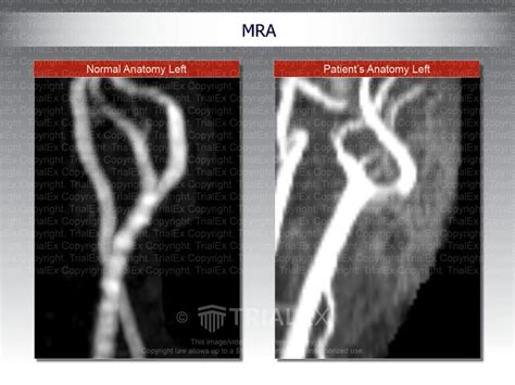 MRA Comparison - TrialExhibits Inc.