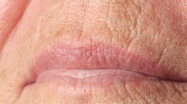 Upper Lip Wrinkles Treatment - Melbourne