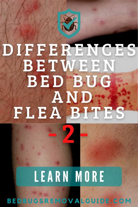 Bed bug bites are bigger than flea bites, and flea bites tend to be ...