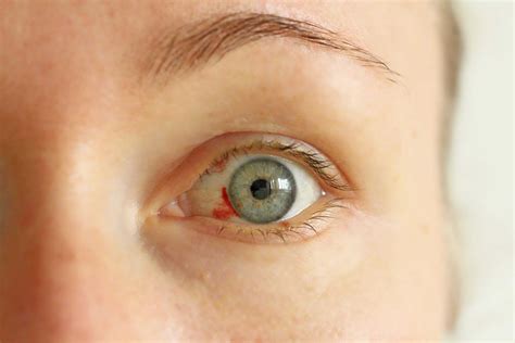 Corneal Laceration: Causes, Symptoms, Diagnosis And Treatment - accuspire