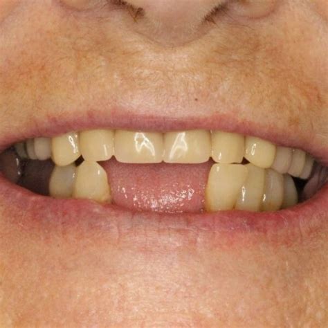 Before and After Dentures - Kevin Manners Denture Clinics