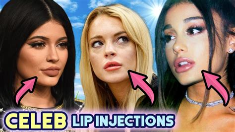 Celebrities With Good Lip Fillers | Ownerlip.co